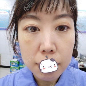 不明白為什么有人做內(nèi)切祛眼袋會(huì)后悔 反正我割眼袋10天后效果挺明顯的