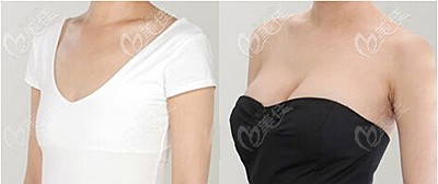 陳德裕院長的隆胸案例