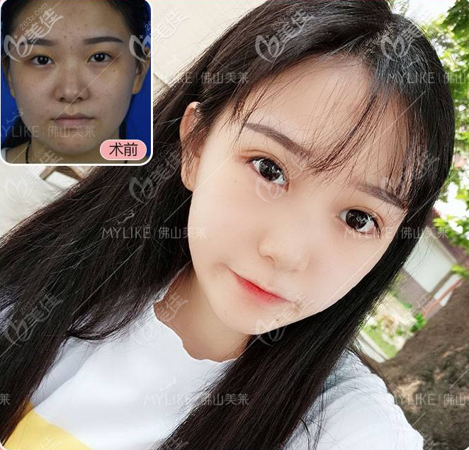 佛山美萊整形醫(yī)院雙眼皮效果圖 佛山美萊整形醫(yī)院雙眼皮效果圖