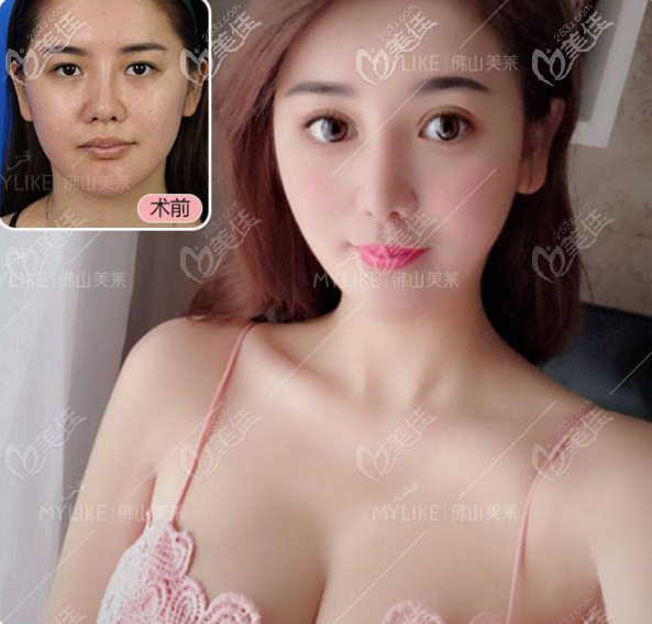 佛山美萊王燕做的雙眼皮效果圖 佛山美萊王燕做的雙眼皮效果圖