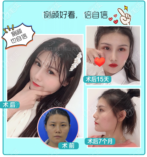 佛山美萊王燕雙眼皮隆鼻效果圖 佛山美萊王燕雙眼皮隆鼻效果圖