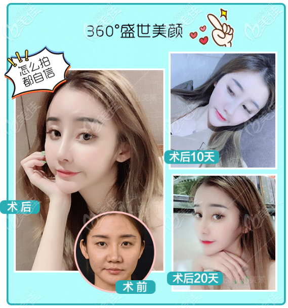 佛山美萊王燕鼻綜合隆鼻效果圖 佛山美萊王燕鼻綜合隆鼻效果圖