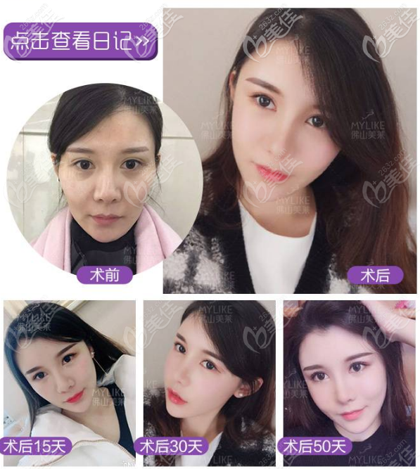 佛山美萊張濤自體脂肪面部填充效果圖 佛山美萊張濤自體脂肪面部填充效果圖