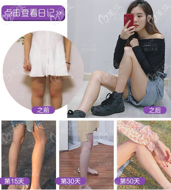 佛山美萊大腿吸脂效果圖 佛山美萊大腿吸脂效果圖