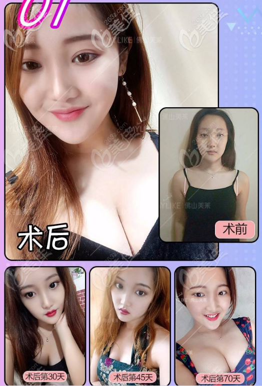 佛山美萊假體隆胸效果圖 佛山美萊假體隆胸效果圖