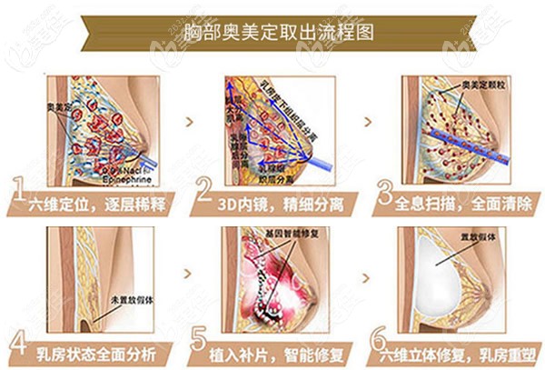 胸部奧美定取出流程