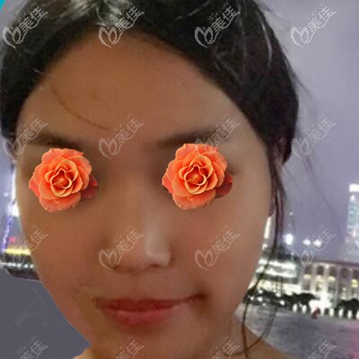 做肋軟骨鼻綜合術(shù)前照 做肋軟骨鼻綜合術(shù)前照