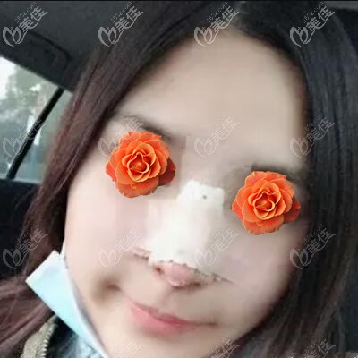 肋軟骨鼻綜合術(shù)后第3天照 肋軟骨鼻綜合術(shù)后第3天照