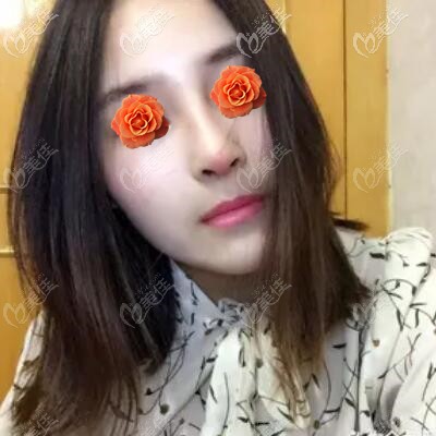 做肋軟骨鼻綜合術(shù)后10天恢復(fù)照 做肋軟骨鼻綜合術(shù)后10天恢復(fù)照