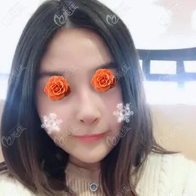 做肋軟骨鼻綜合術(shù)后1個(gè)月恢復(fù)照 做肋軟骨鼻綜合術(shù)后1個(gè)月恢復(fù)照