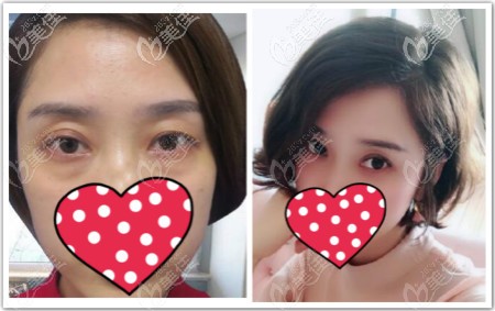超聲波祛眼袋三個(gè)月效果圖 超聲波祛眼袋三個(gè)月效果圖