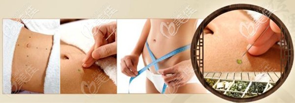 李秀格醫(yī)生擅長做埋線減肥 李秀格醫(yī)生擅長做埋線減肥