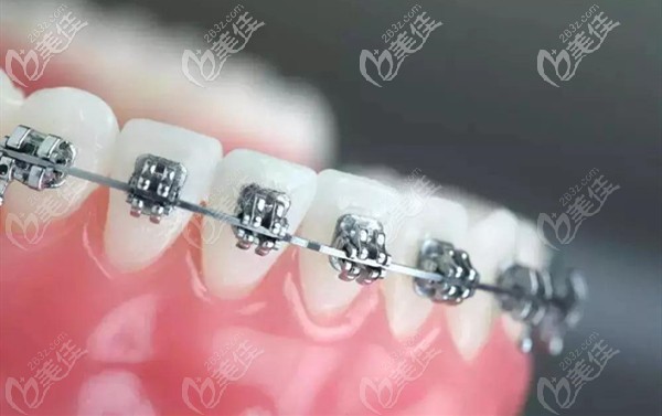 自鎖托槽矯正器 自鎖托槽矯正器