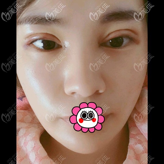 雙眼皮術(shù)后恢復2天腫脹厲害 雙眼皮術(shù)后恢復2天腫脹厲害