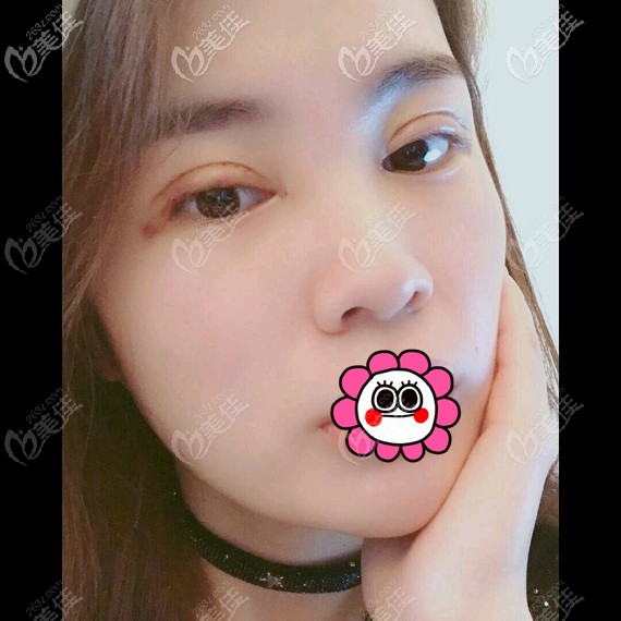 術(shù)后7天拆線后雙眼皮恢復情況 術(shù)后7天拆線后雙眼皮恢復情況