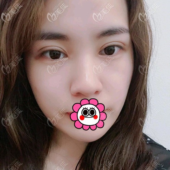 雙眼皮恢復一個月線條流暢 雙眼皮恢復一個月線條流暢