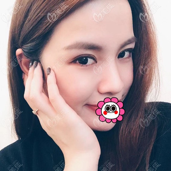 嘉興禾美趙學(xué)燕做眼睛怎么樣得從他做的7mm全切雙眼皮恢復(fù)三個(gè)月案例來看