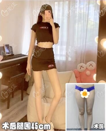 抖音人氣旺旺珂珂大腿吸脂術(shù)后對(duì)比效果 抖音人氣旺旺珂珂大腿吸脂術(shù)后對(duì)比效果