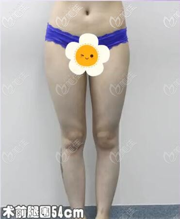 成都艾米麗大腿吸脂術(shù)前照片 成都艾米麗大腿吸脂術(shù)前照片