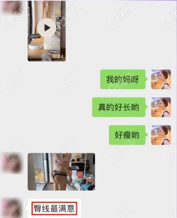 珂珂大腿吸脂術(shù)后真是反饋 珂珂大腿吸脂術(shù)后真是反饋