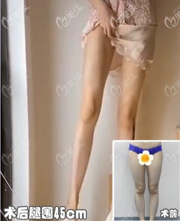 抽脂瘦大腿效果明顯嗎?抖音網(wǎng)紅珂珂大腿吸脂術(shù)后腿圍直降9cm!