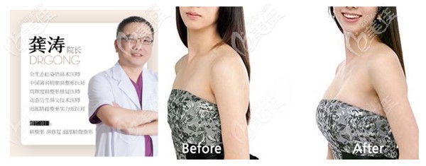 寧波<i data-id='dad92877-5779-44d2-90dd-2438c6ee1bdf' style='display:none;'></i>醫(yī)院做隆胸手術(shù)療效對(duì)比 寧波<i data-id='dad92877-5779-44d2-90dd-2438c6ee1bdf' style='display:none;'></i>醫(yī)院做隆胸手術(shù)療效對(duì)比