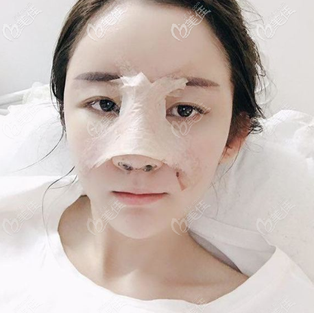 做完鼻綜合隆鼻5天恢復期效果圖