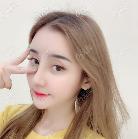 很滿意佛山美萊王燕醫(yī)生給我做的鼻子啊