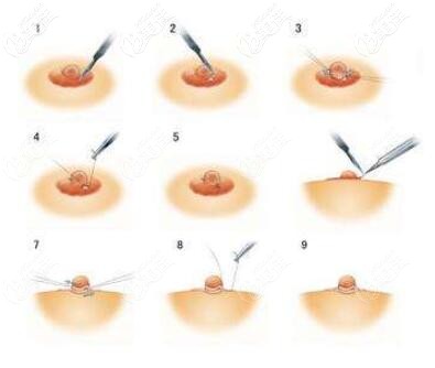 乳頭內(nèi)陷矯正手術(shù)過程