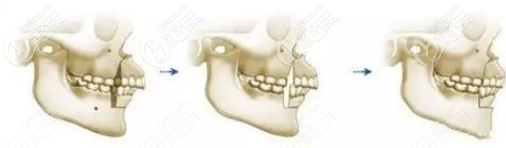 上下頜手術(shù)矯正 上下頜手術(shù)矯正