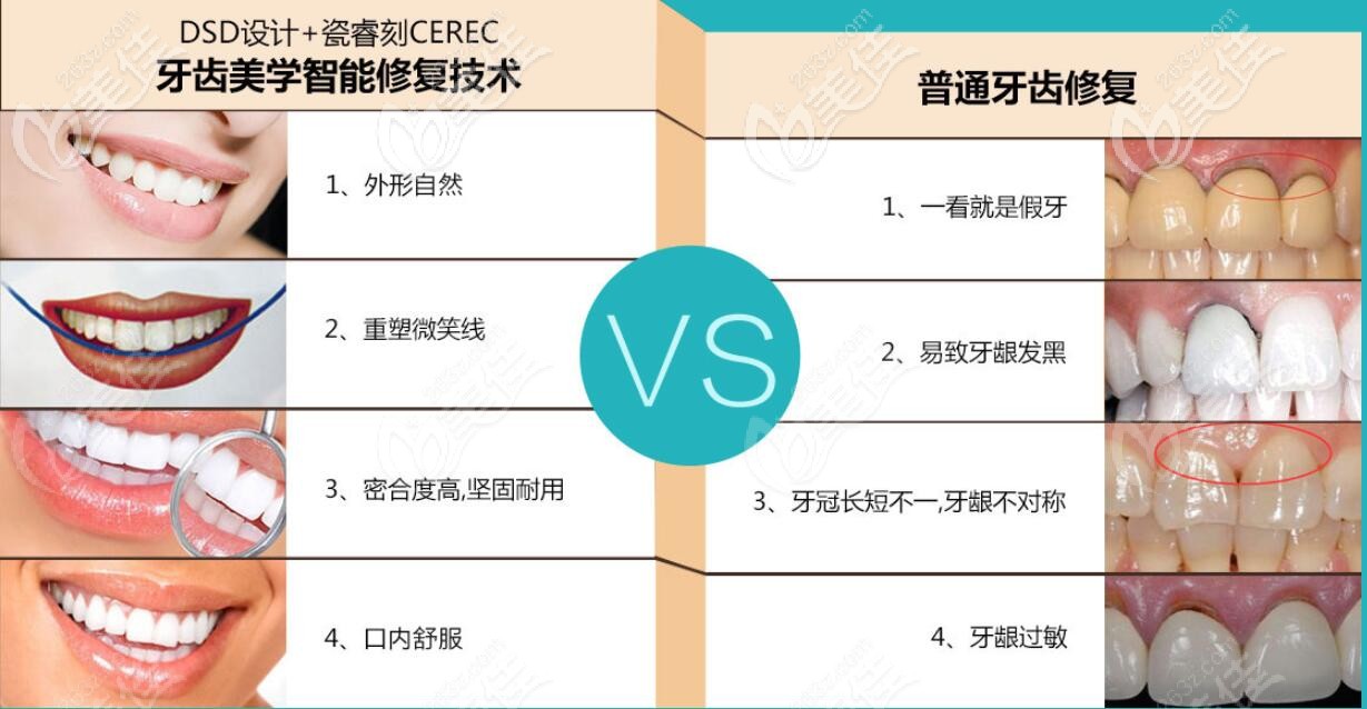 DSD美學修復和普通牙齒修復差別是很大的