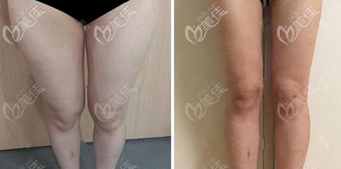 廣州曙光大腿吸脂案例