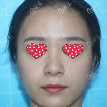 假體墊下巴術(shù)前照 假體墊下巴術(shù)前照