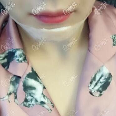 做假體墊下巴手術(shù)當(dāng)天 做假體墊下巴手術(shù)當(dāng)天