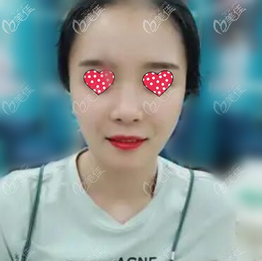 假體墊下巴術(shù)后10天恢復(fù)照 假體墊下巴術(shù)后10天恢復(fù)照