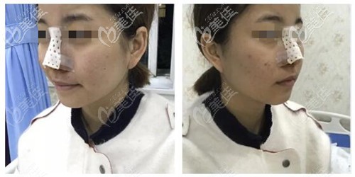 鼻綜合術(shù)后效果