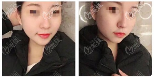 鼻翼縮小外切12天