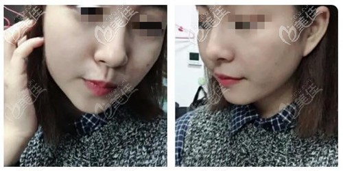 鼻綜合恢復(fù)3個(gè)月效果