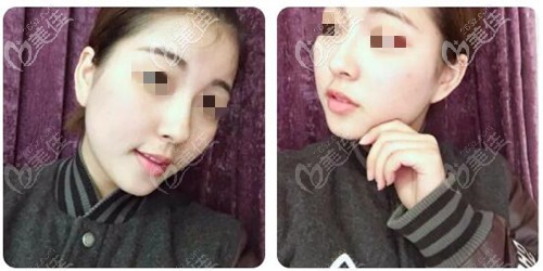 為什么醫(yī)生不建議鼻翼縮小?我做的一萬多鼻綜合解決大鼻頭就挺靠譜的