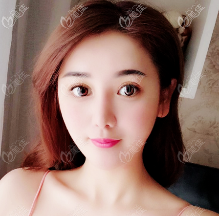 佛山美萊王燕做的雙眼皮也太好看了吧