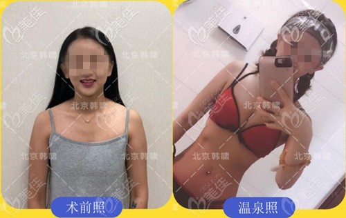 棉花糖豐胸前后對比案例