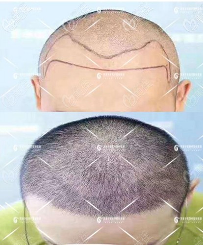 菏澤華美發(fā)際線種植15天效果圖 菏澤華美發(fā)際線種植15天效果圖