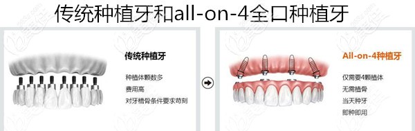 老年人做全口種植牙要幾十萬嗎