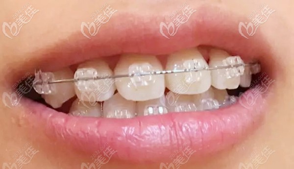 冰晶托槽牙套矯治器