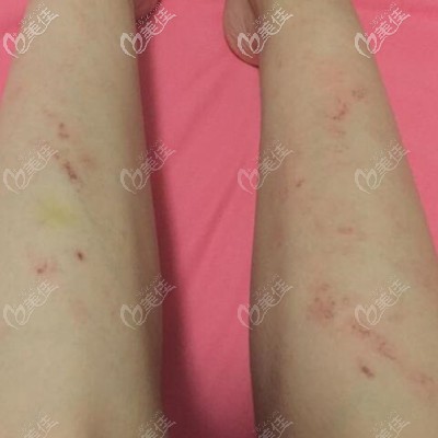 冰點(diǎn)脫毛術(shù)后可以會(huì)出現(xiàn)的紅色疙瘩