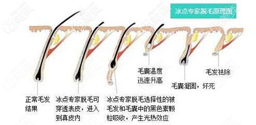 采用冰點(diǎn)脫毛的手術(shù)原理圖