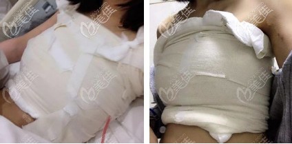 剛做完隆胸手術(shù)胸部腫脹 剛做完隆胸手術(shù)胸部腫脹