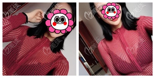 假體隆胸術(shù)后20天胸部基本恢復(fù) 假體隆胸術(shù)后20天胸部基本恢復(fù)