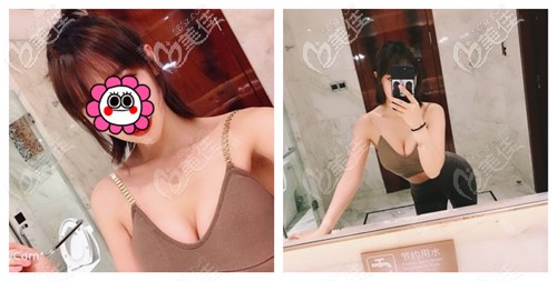 聽(tīng)網(wǎng)友說(shuō)進(jìn)口曼托假體275過(guò)大 就選擇做水滴型225cc假體隆胸術(shù)后效果超自然