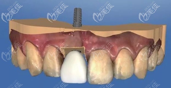 前牙區(qū)的種植示意圖